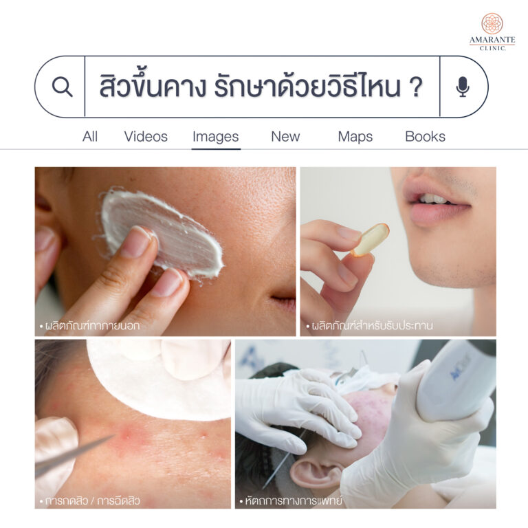 สิวขึ้นที่คาง รักษาด้วยวิธีไหนดี?