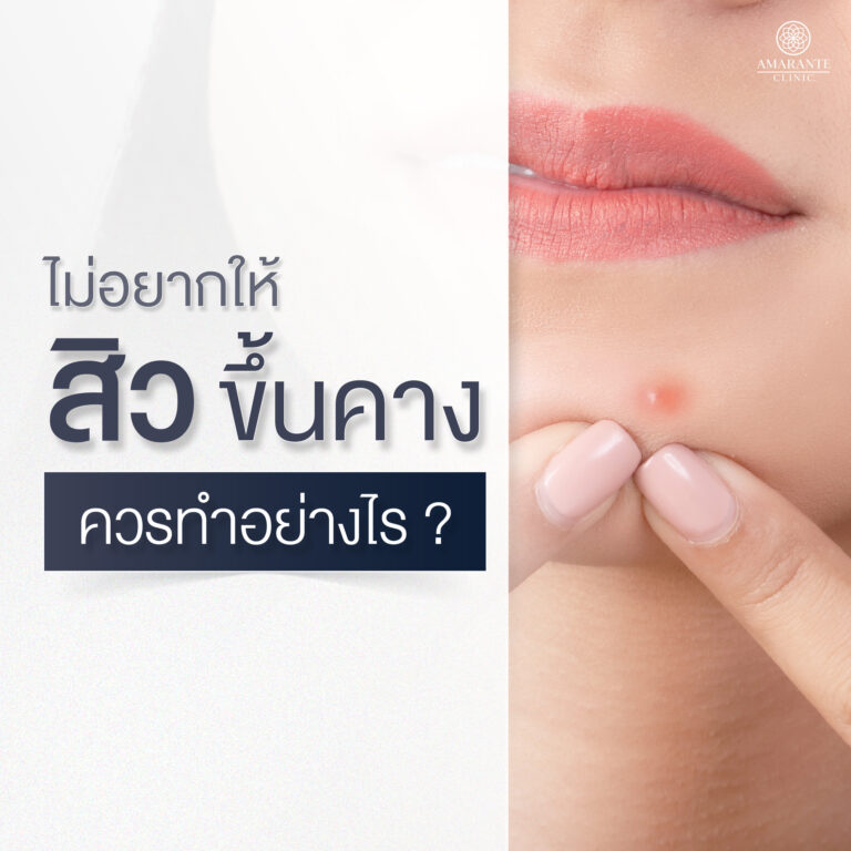 ไม่อยากให้สิวขึ้นที่คางขึ้น ควรทำอย่างไร