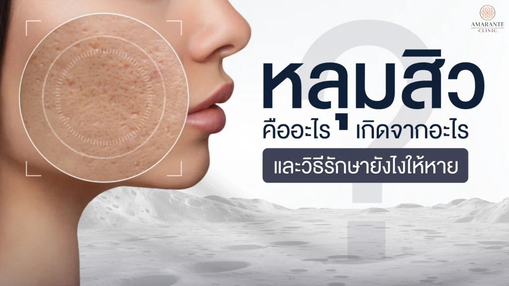 หลุมสิว คืออะไร เกิดจากอะไร และวิธีรักษายังไงให้หาย