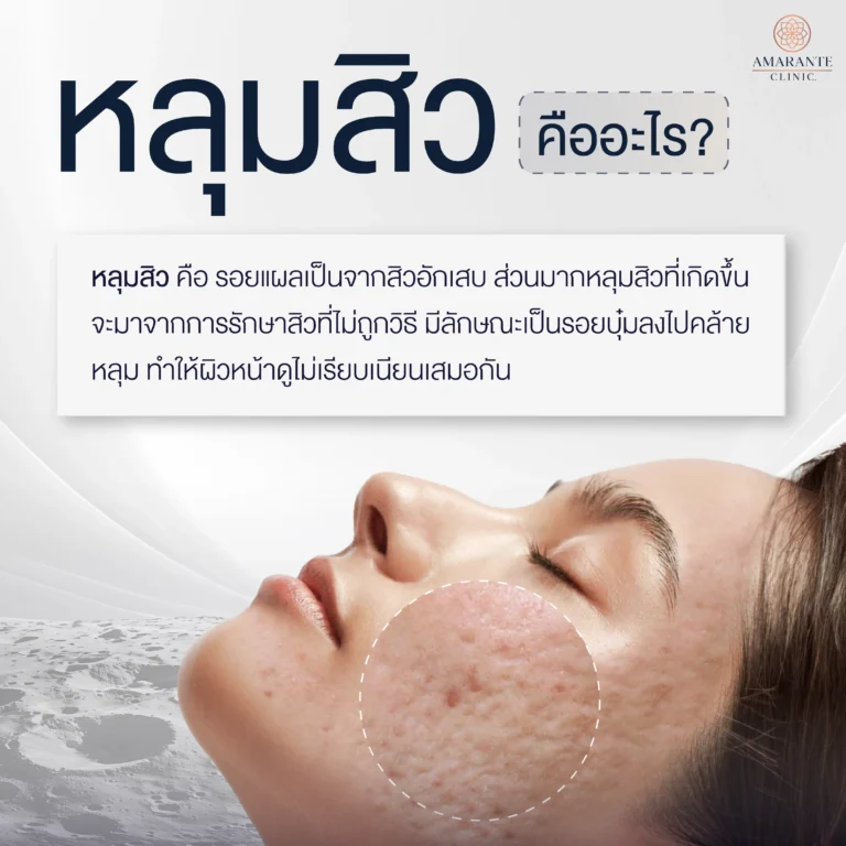 หลุมสิว คืออะไร