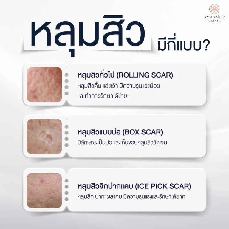 หลุมสิว มีกี่แบบ