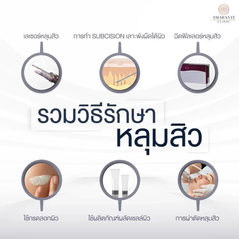 รักษาหลุมสิวอย่างไรให้หาย