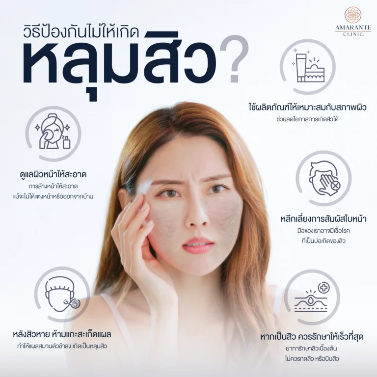 วิธีป้องกันไม่ให้เกิดหลุมสิว