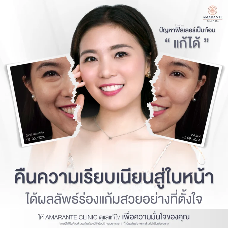 ภาพโฆษณา แก้ไขฟิลเลอร์ ที่ Amarante Clinic