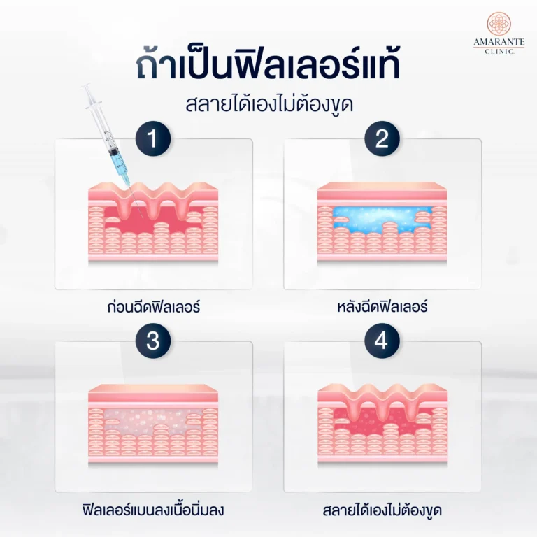 ถ้าเป็นฟิลเลอร์แท้ สลายได้เองไม่ต้องขูด