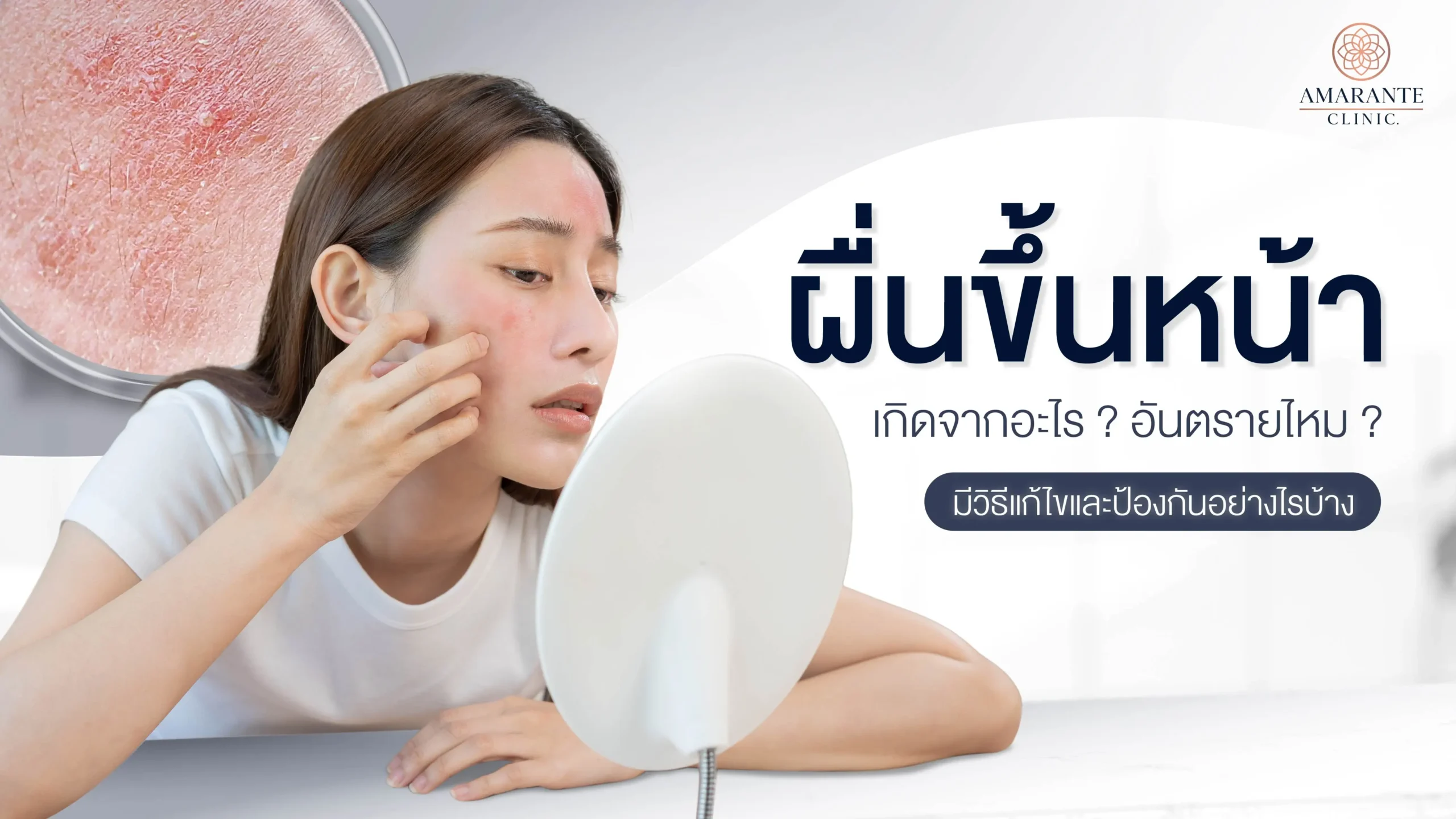 ปกภาพบทความ ผื่นขึ้นหน้าเกิดจากอะไร มีวิธีแก้ไขและป้องกันอย่างไรบ้าง