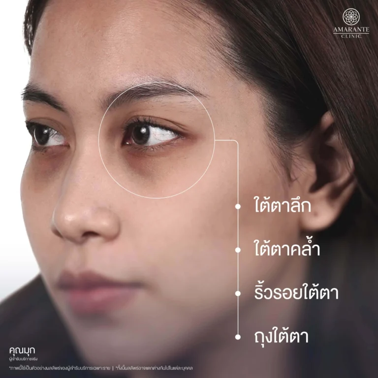 คุณมุก ปัญหาถุงใต้ตา