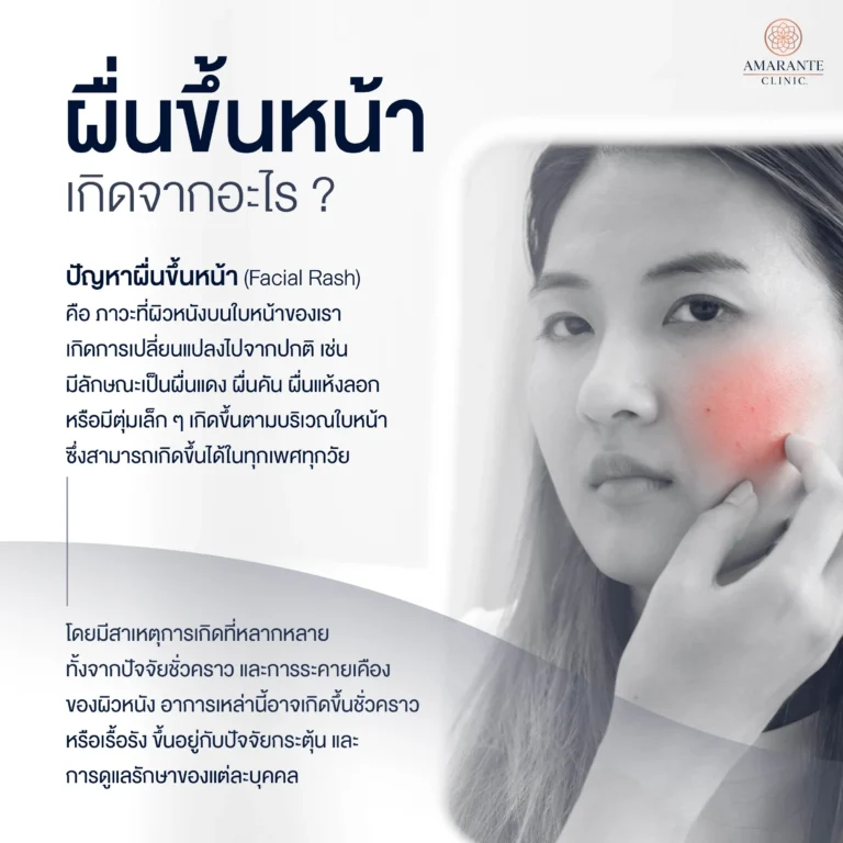 ผื่นขึ้นหน้า คืออะไร?