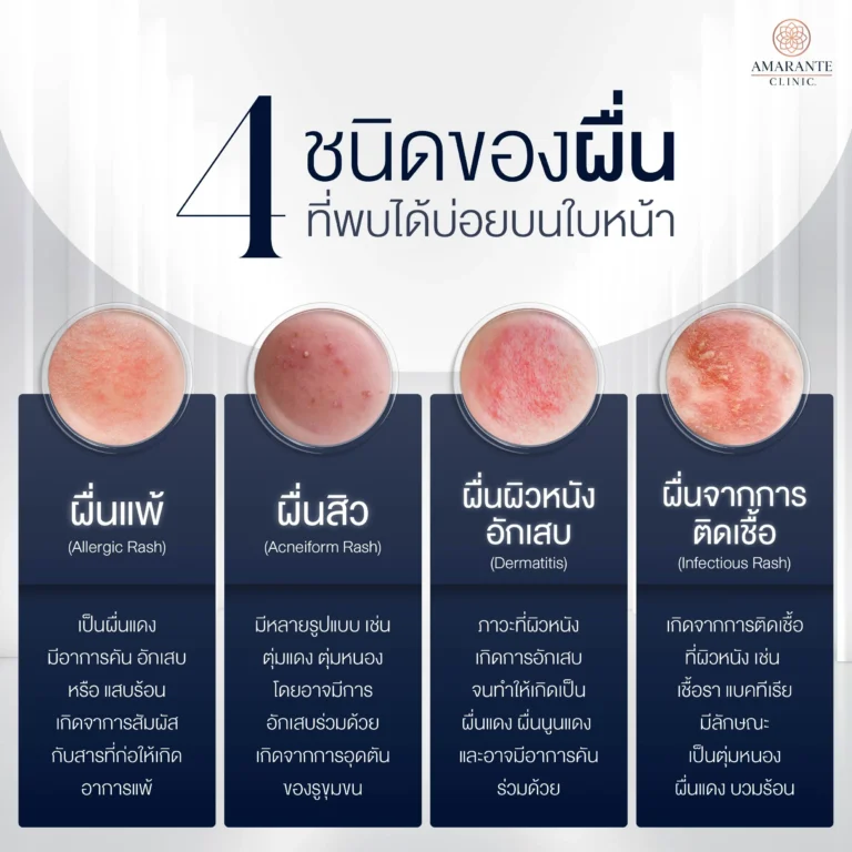 ผื่นขึ้นหน้ามีกี่ประเภท?