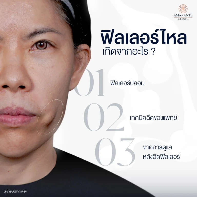 ฟิลเลอร์ไหลเกิดจากอะไร