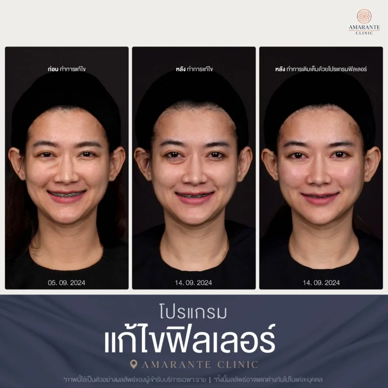 ภาพ Before and After แก้ไขฟิลเลอร์และเติมฟิลเลอร์ 09-2024 เคส 2.webp