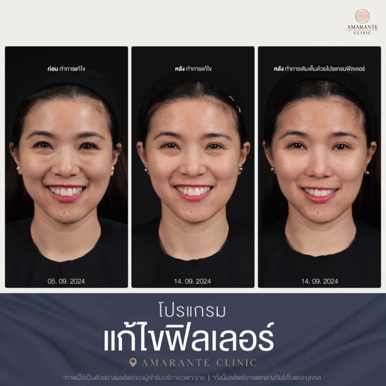 ภาพ Before and After แก้ไขฟิลเลอร์และเติมฟิลเลอร์ 09-2024