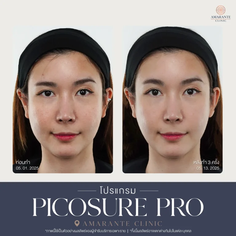 รีวิว Pico Pro Laser รูปที่ 18