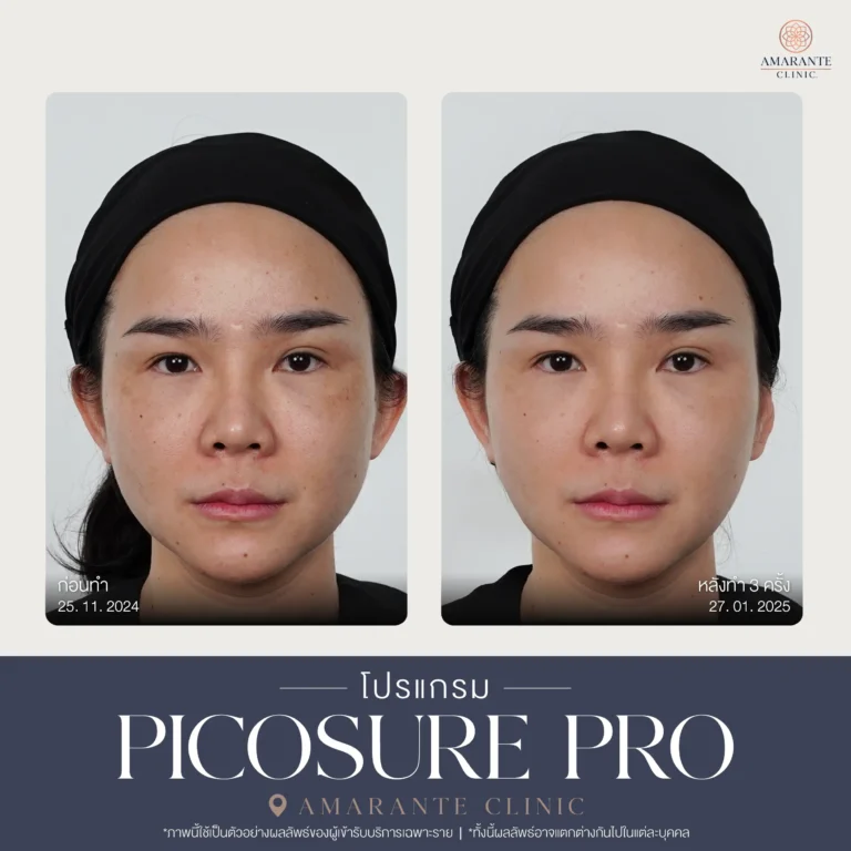 รีวิว Pico Pro Laser รูปที่ 14