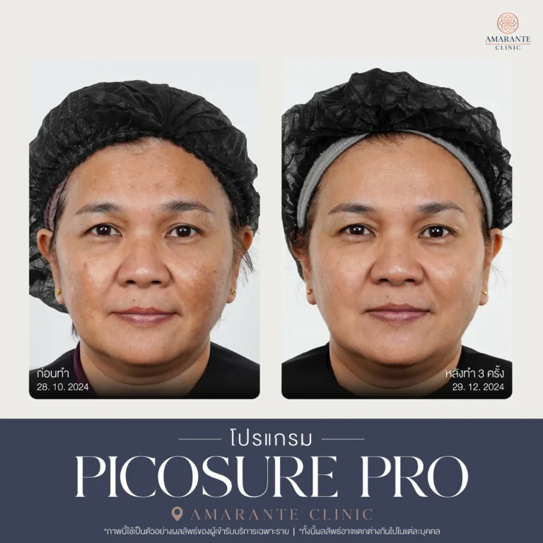 รีวิว Pico Pro Laser รูปที่ 13