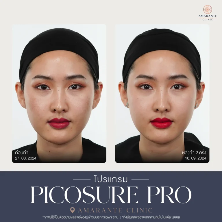 รีวิว Pico Pro Laser รูปที่ 6