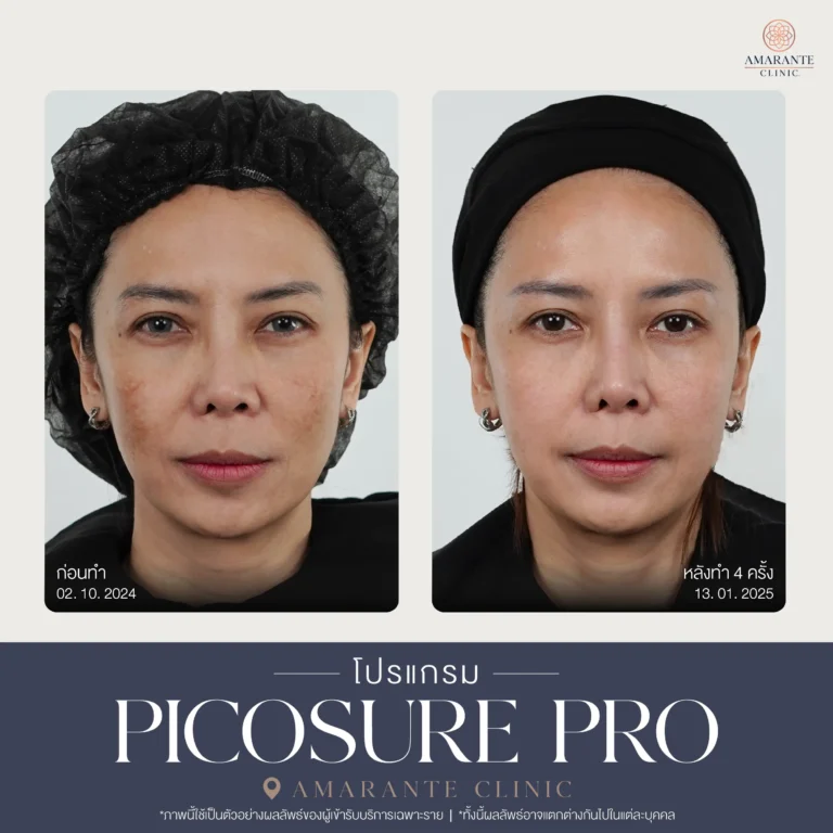 รีวิว Pico Pro Laser รูปที่ 5