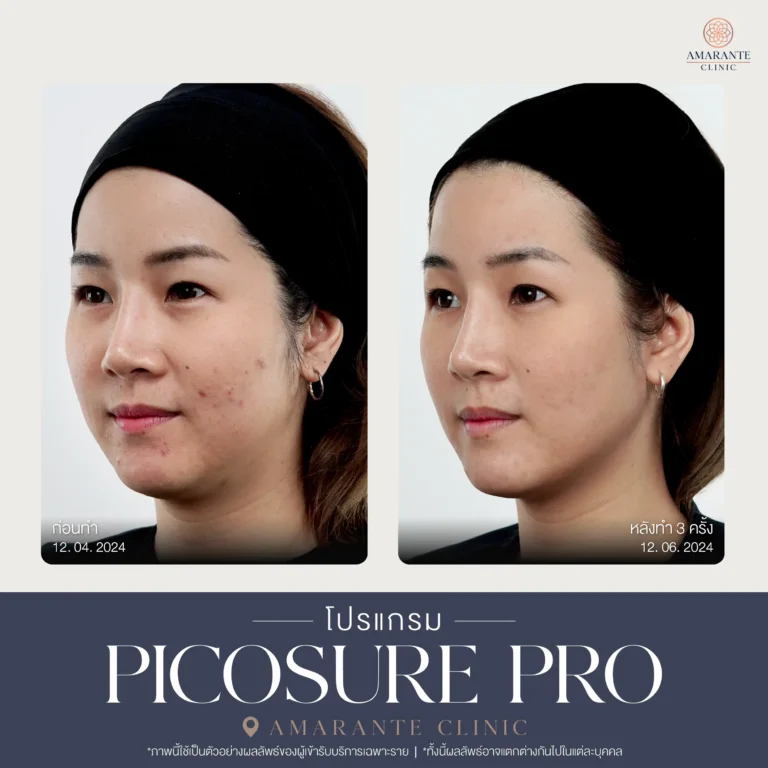 รีวิว Pico Pro Laser รูปที่ 4