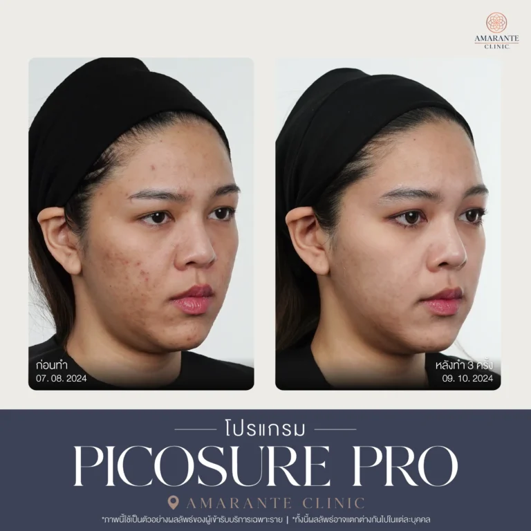 รีวิว Pico Pro Laser รูปที่ 3