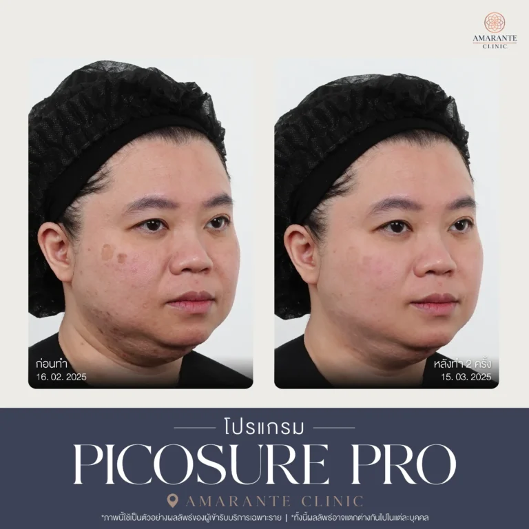 รีวิว Pico Pro Laser รูปที่ 2