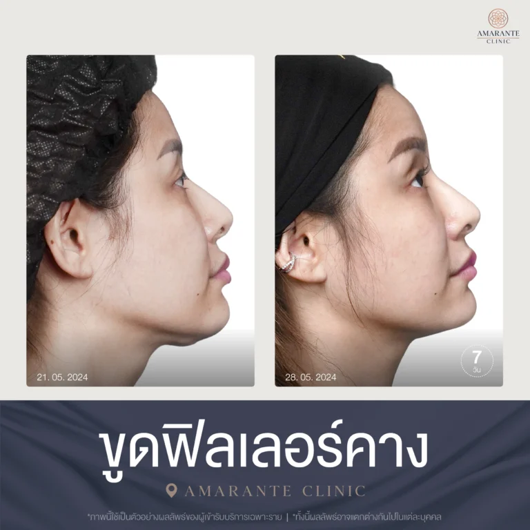 เคสรีวิว ขูดฟิลเลอร์คาง ที่ Amarante Clinic 05-2024