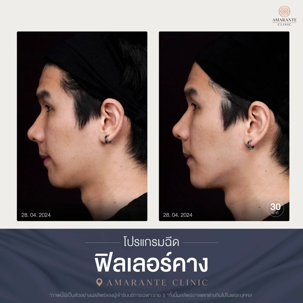 เคสรีวิวโปรแกรมฉีดฟิลเลอร์คาง Before and After 04-2024