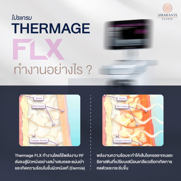 Thermage FLX ทำงานอย่างไร