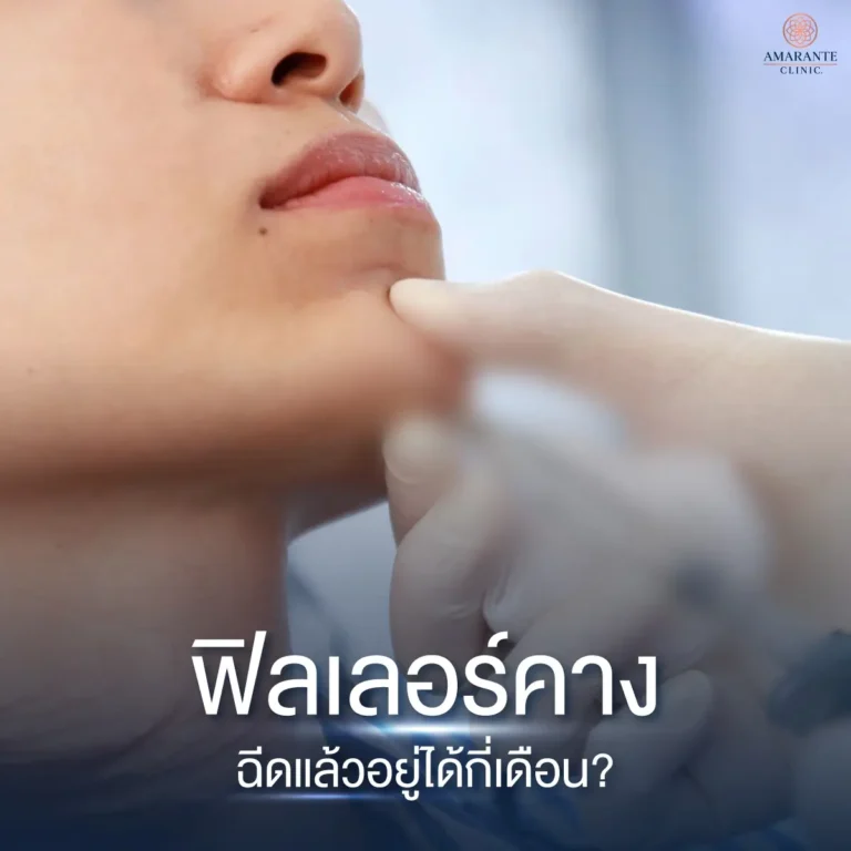 ฟิลเลอร์คางอยู่ได้กี่เดือน?
