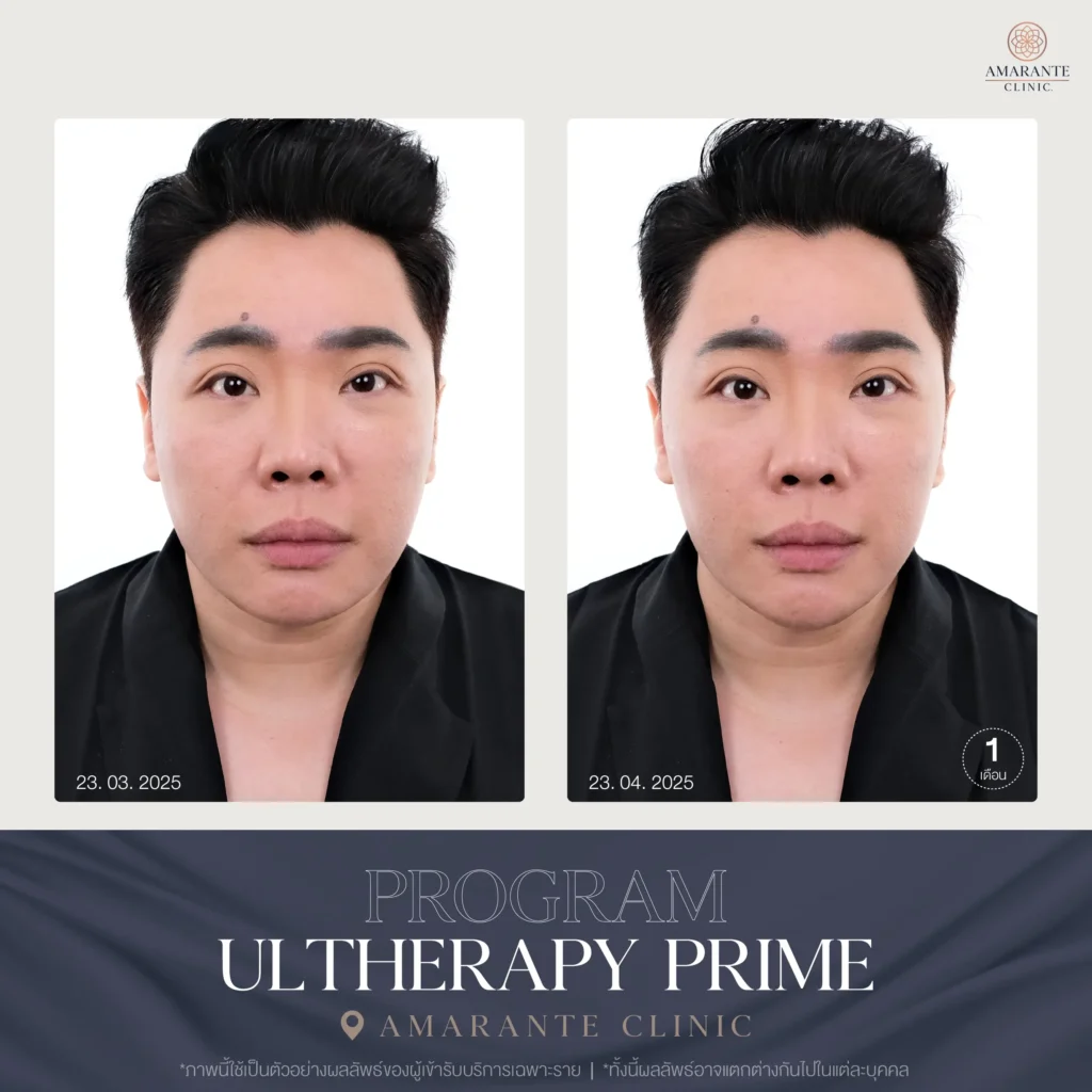 รีวิว แก้ปัญหาใบหน้าไม่สมส่วนมดดำ