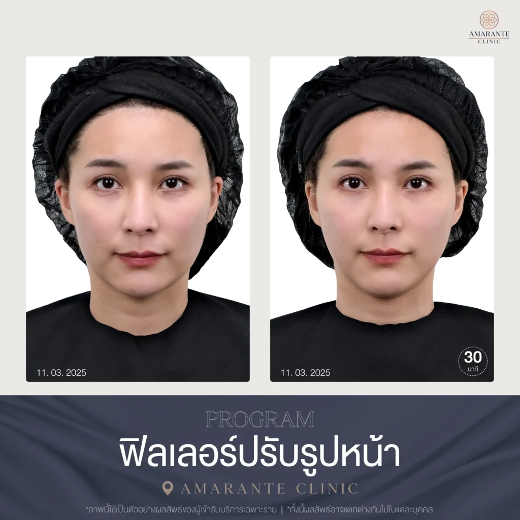 รีวิว แก้ปัญหาใบหน้าไม่สมส่วน 3