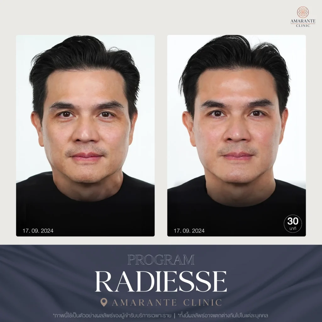 รีวิว แก้ปัญหาใบหน้าไม่สมส่วน 4