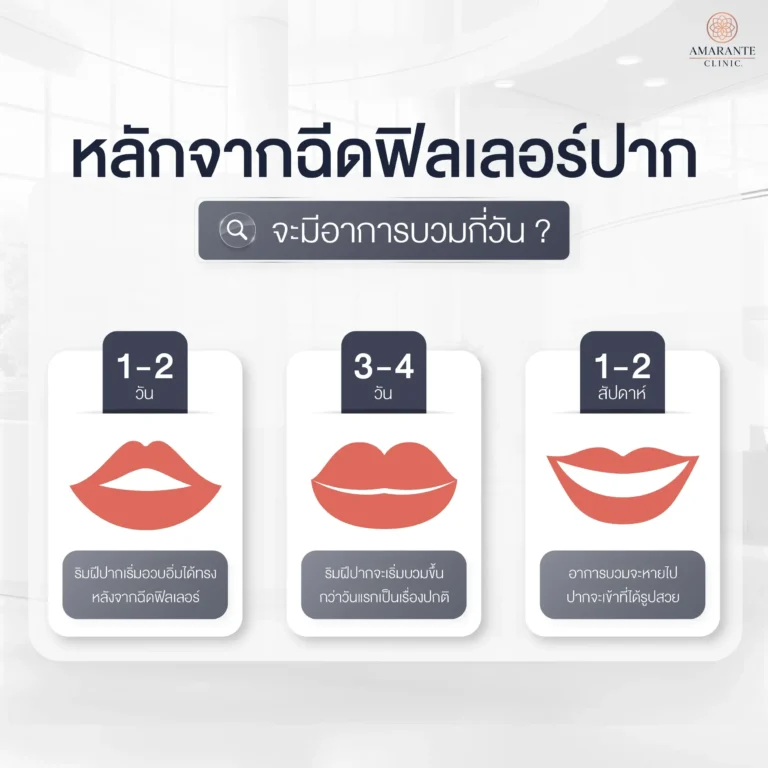ฉีดฟิลเลอร์ปาก บวมกี่วัน