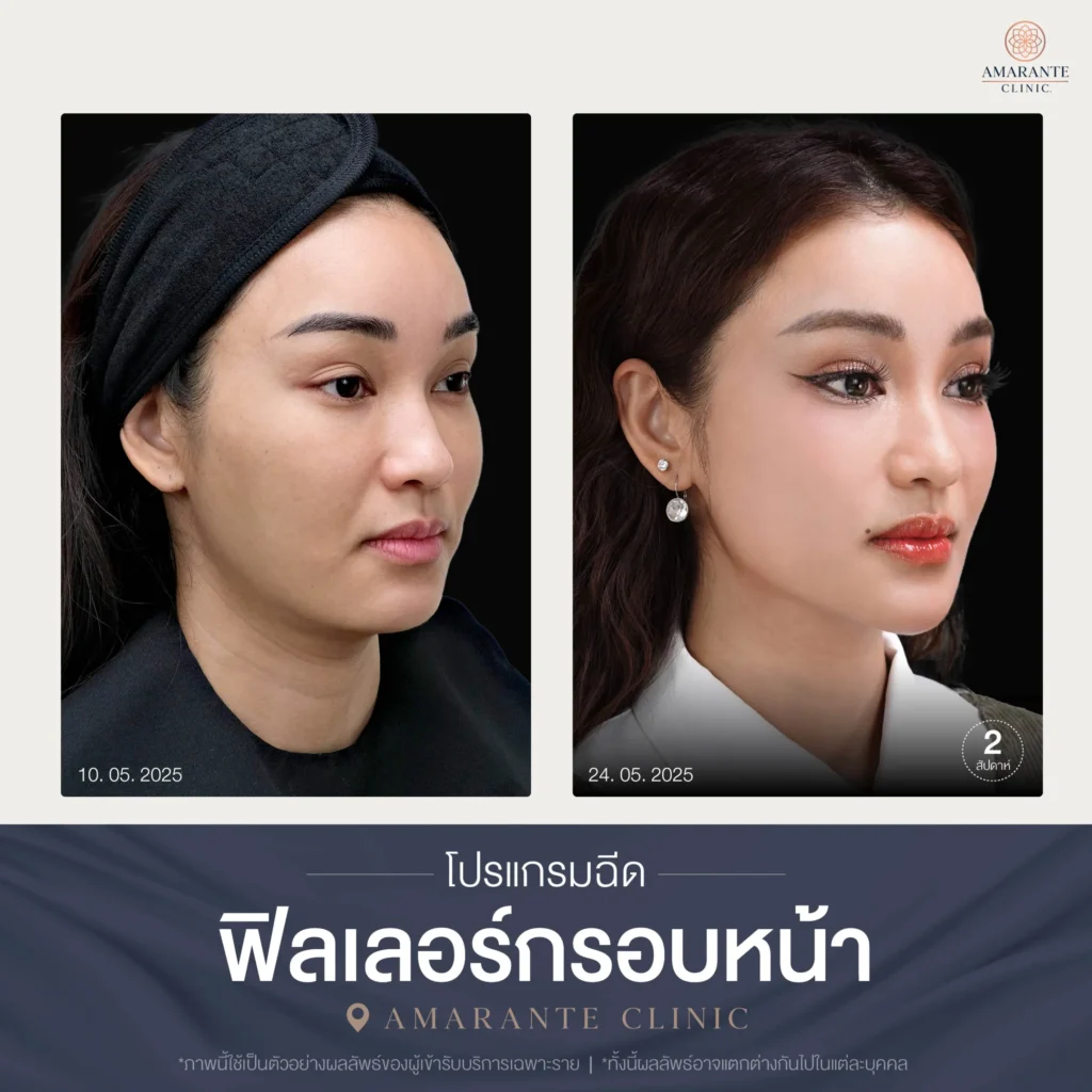โปรแกรมฉีดฟิลเลอร์กรอบหน้า-01-scaled