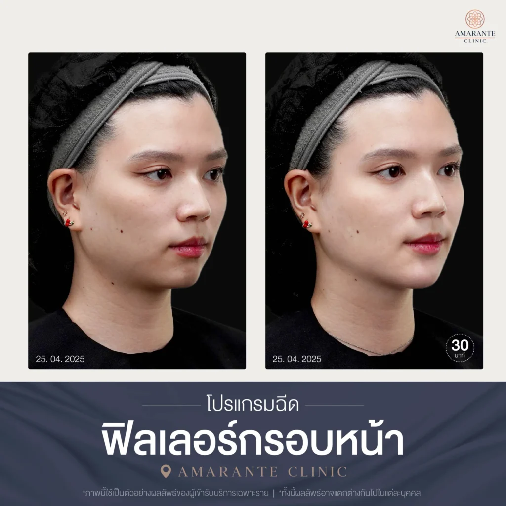 โปรแกรมฉีดฟิลเลอร์กรอบหน้า-02-scaled