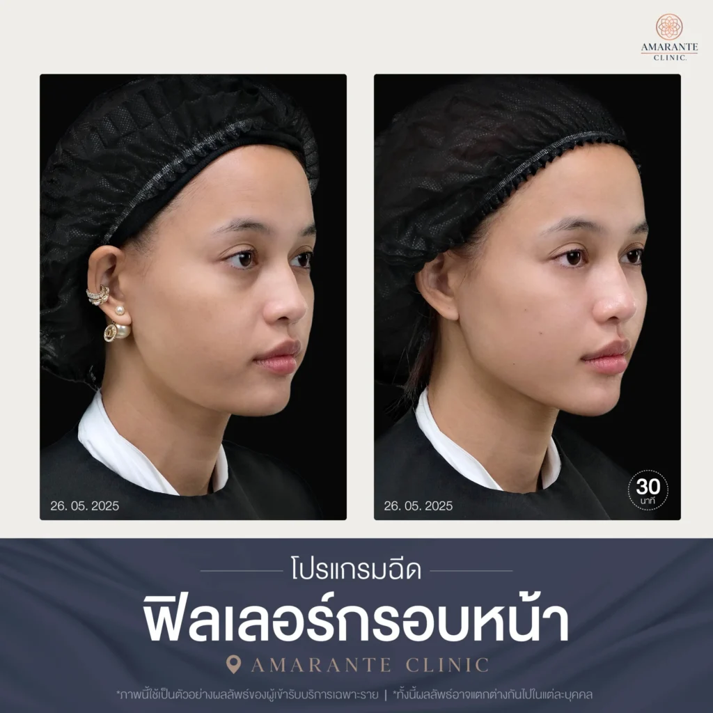 โปรแกรมฉีดฟิลเลอร์กรอบหน้า-03-scaled