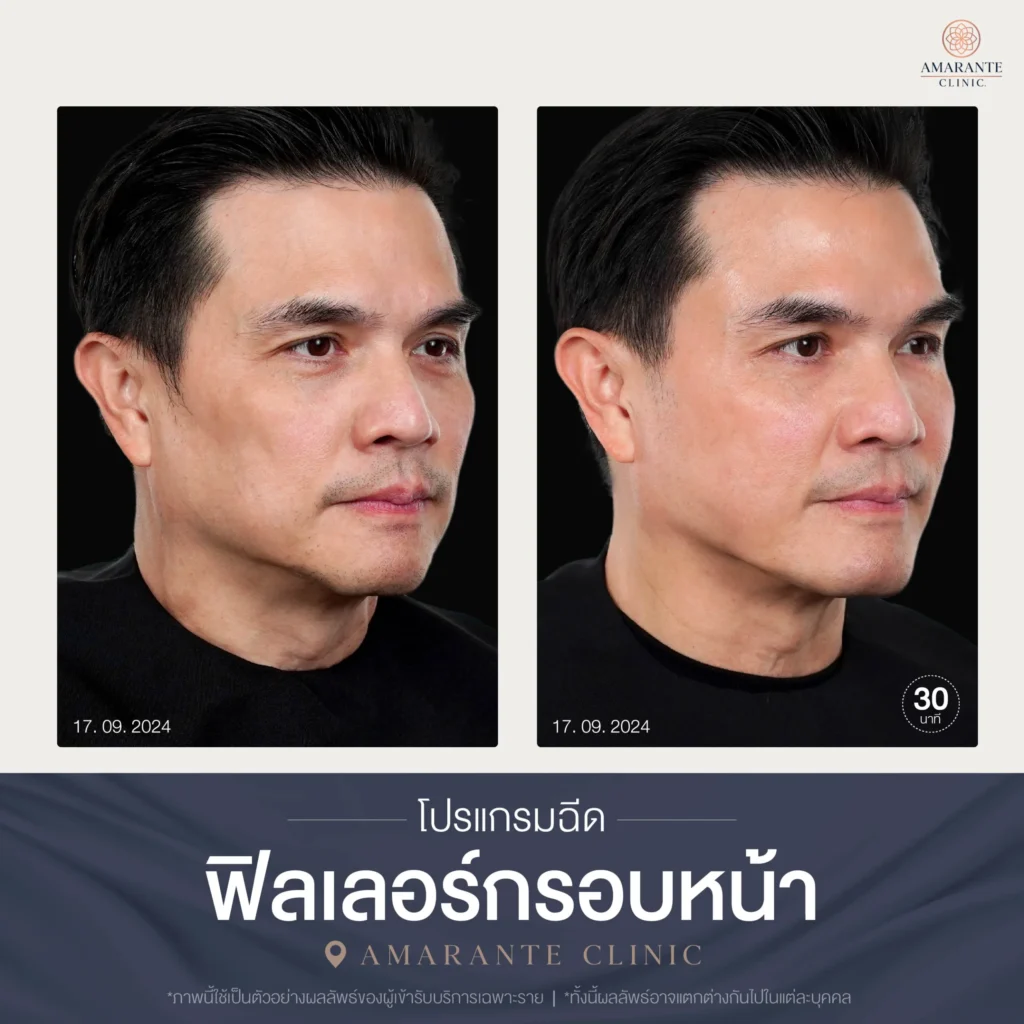 โปรแกรมฉีดฟิลเลอร์กรอบหน้า-04-scaled