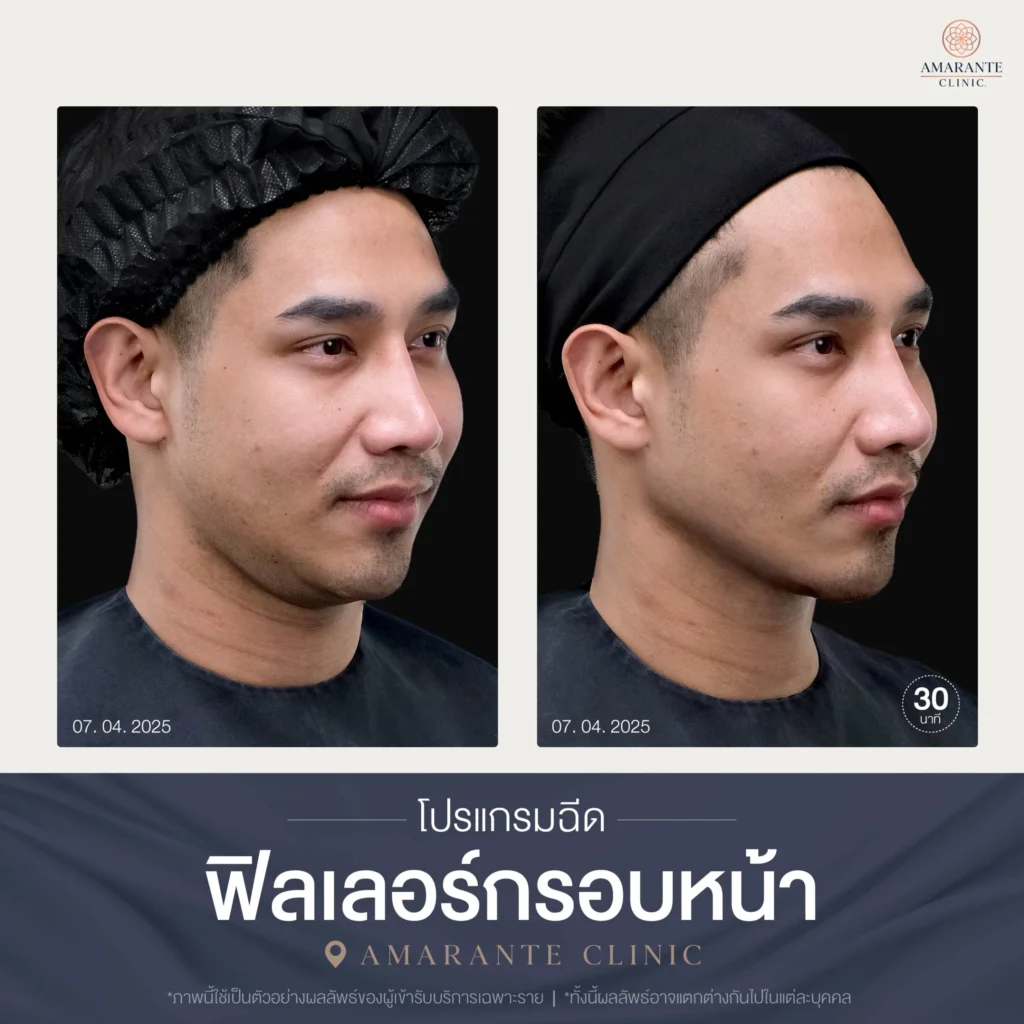 โปรแกรมฉีดฟิลเลอร์กรอบหน้า-05-scaled