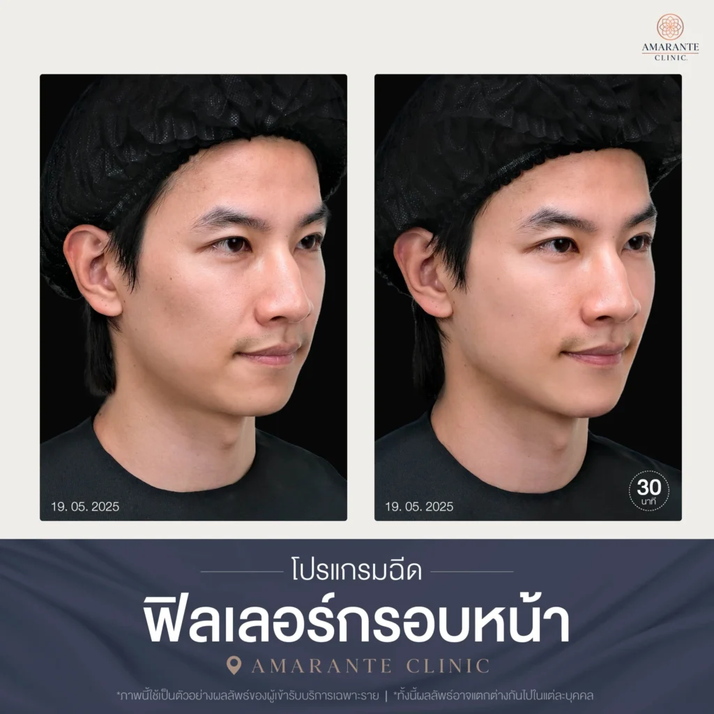 โปรแกรมฉีดฟิลเลอร์กรอบหน้า-06-scaled