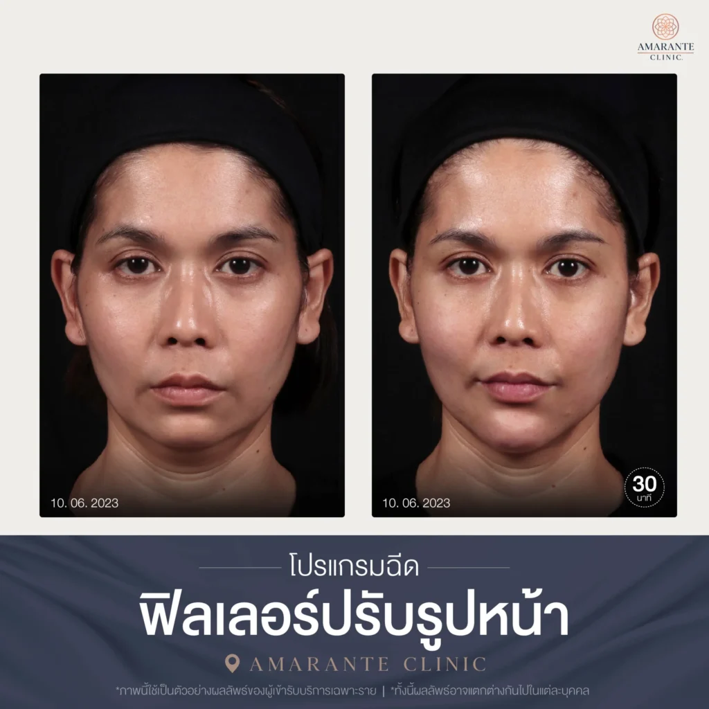 โปรแกรมฉีดฟิลเลอร์ปรับรูปหน้า-01-scaled