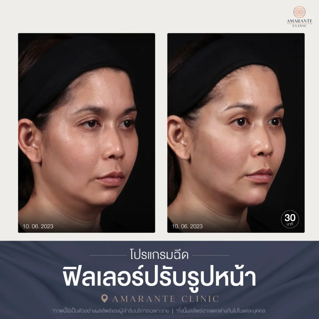 โปรแกรมฉีดฟิลเลอร์ปรับรูปหน้า-02-scaled