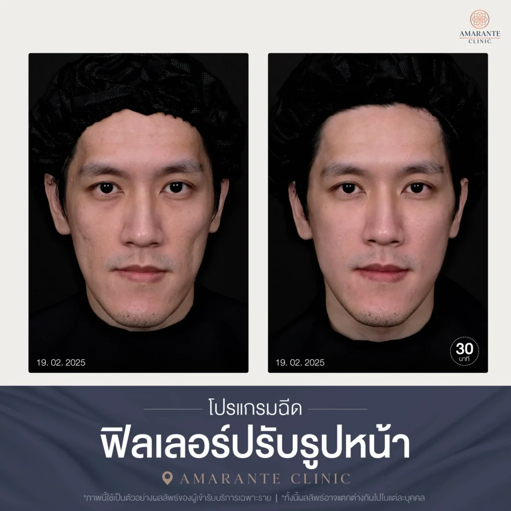โปรแกรมฉีดฟิลเลอร์ปรับรูปหน้า-03-scaled