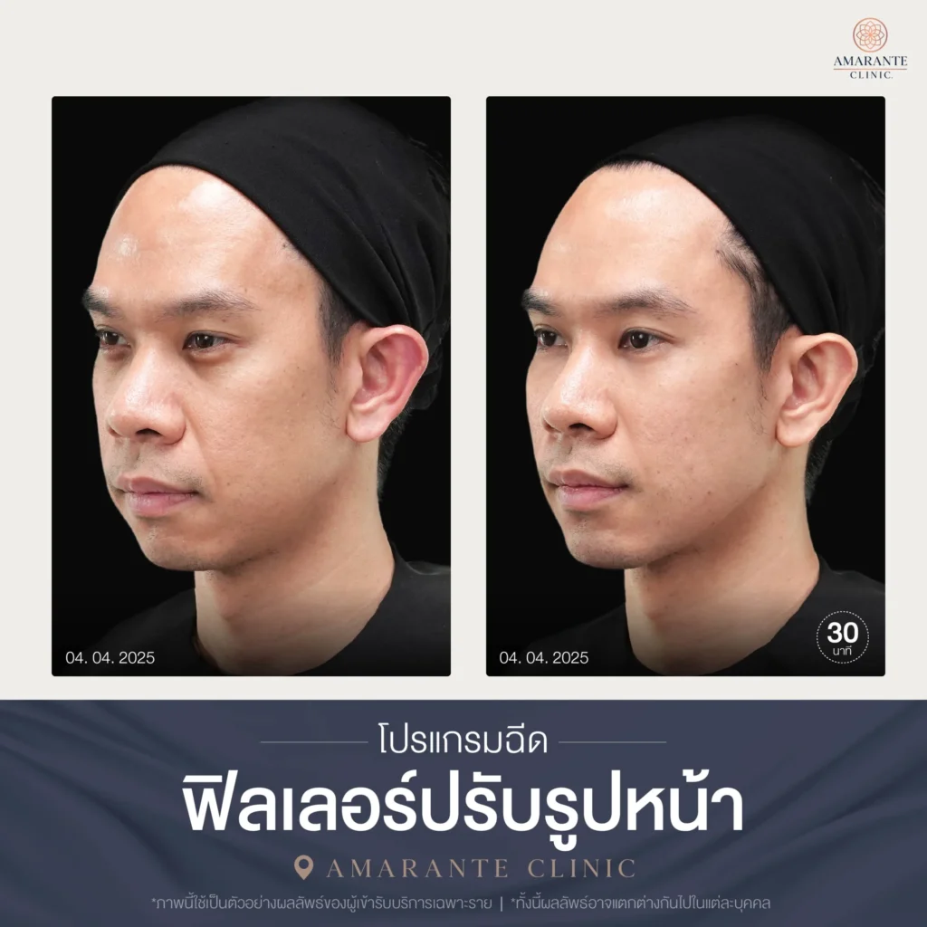 โปรแกรมฉีดฟิลเลอร์ปรับรูปหน้า-06-scaled