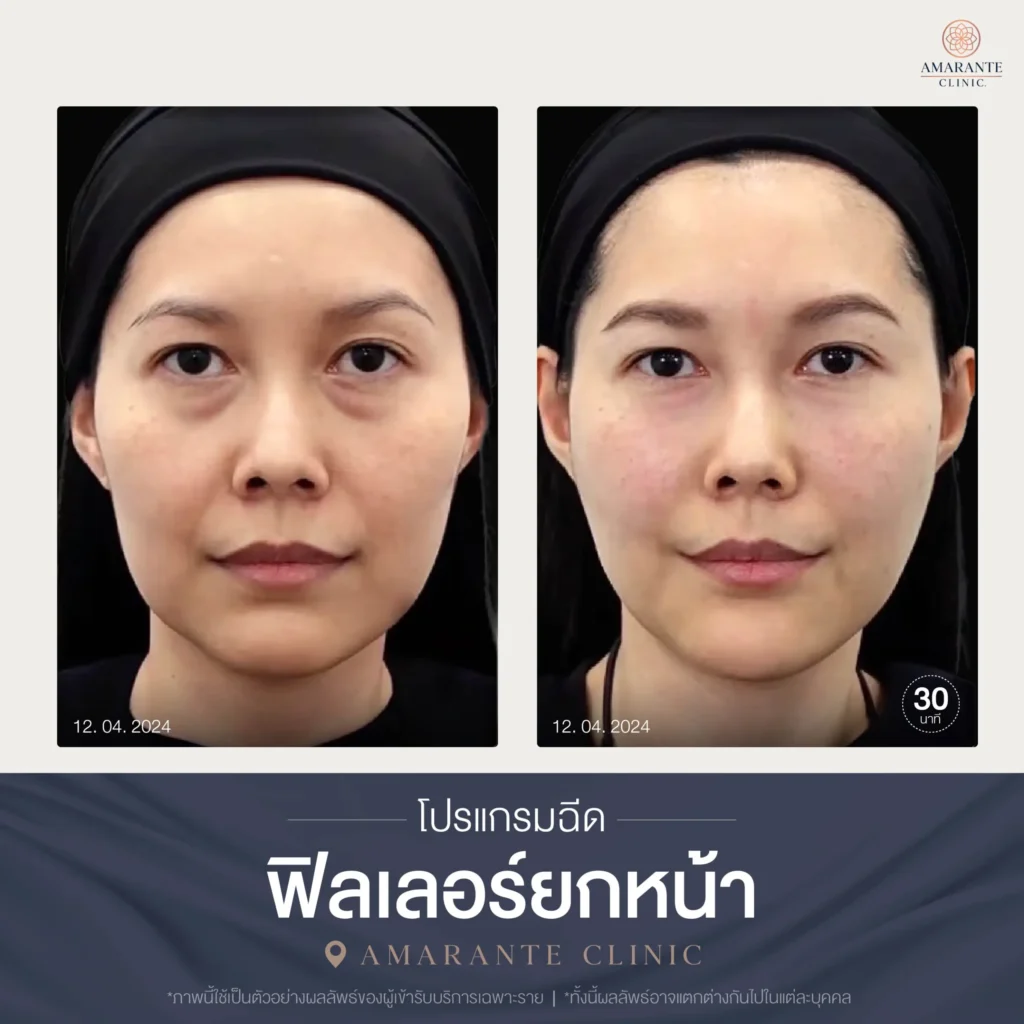 โปรแกรมฉีดฟิลเลอร์ยกหน้า-01-scaled