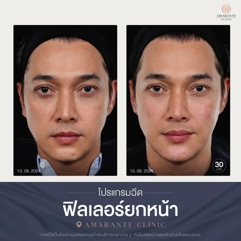 โปรแกรมฉีดฟิลเลอร์ยกหน้า-02-scaled