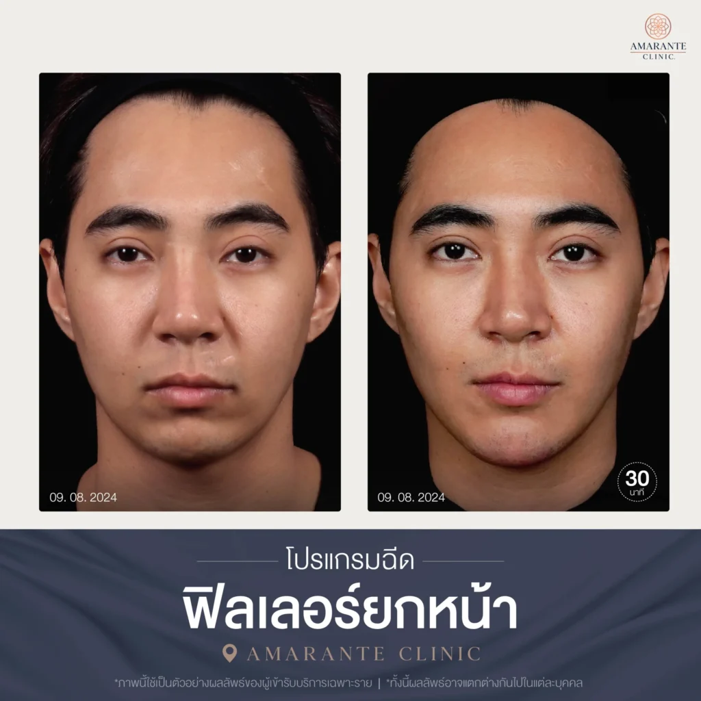 โปรแกรมฉีดฟิลเลอร์ยกหน้า-03-scaled