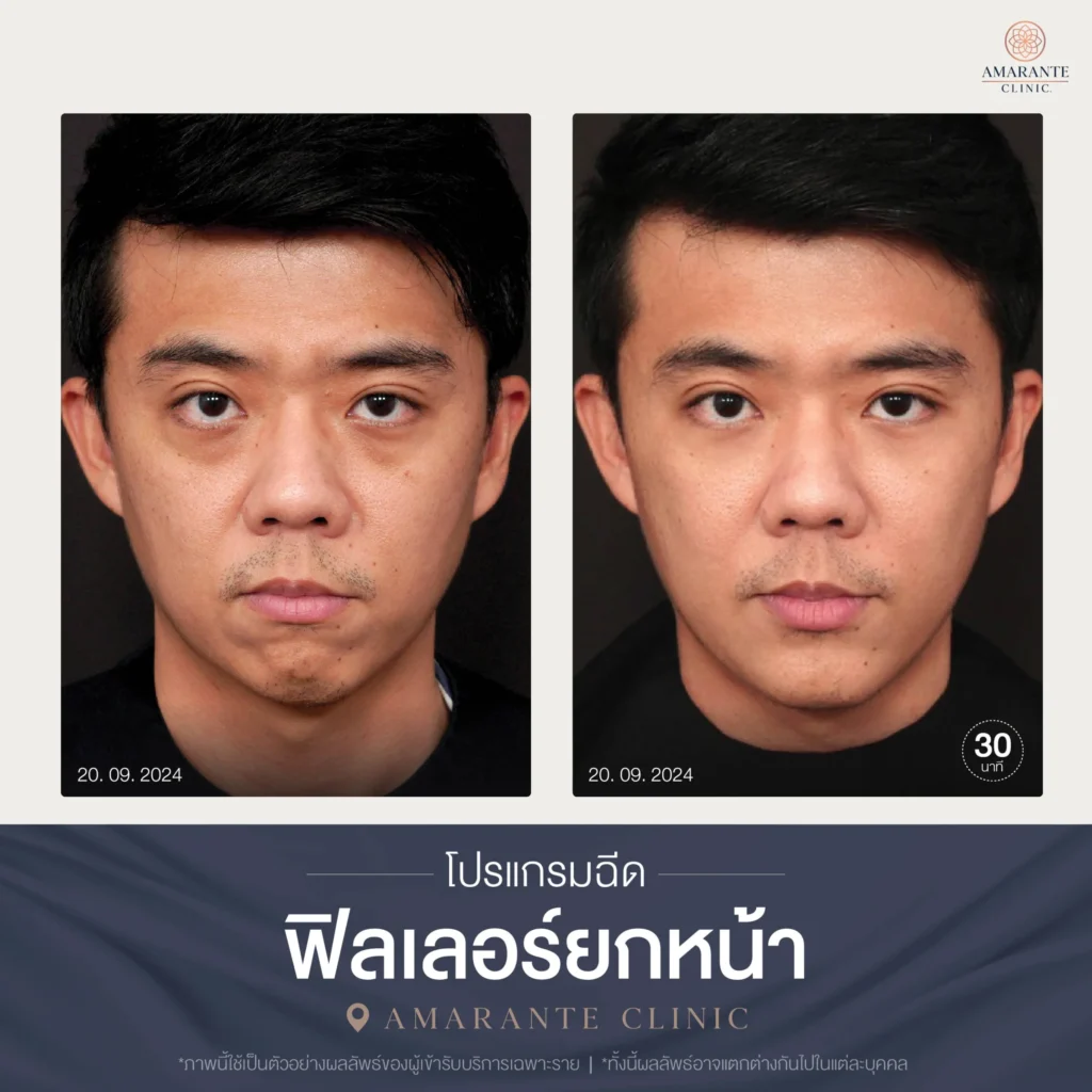 โปรแกรมฉีดฟิลเลอร์ยกหน้า-04-scaled