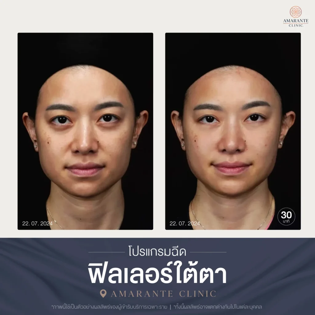 โปรแกรมฉีดฟิลเลอร์ใต้ตา-02-scaled