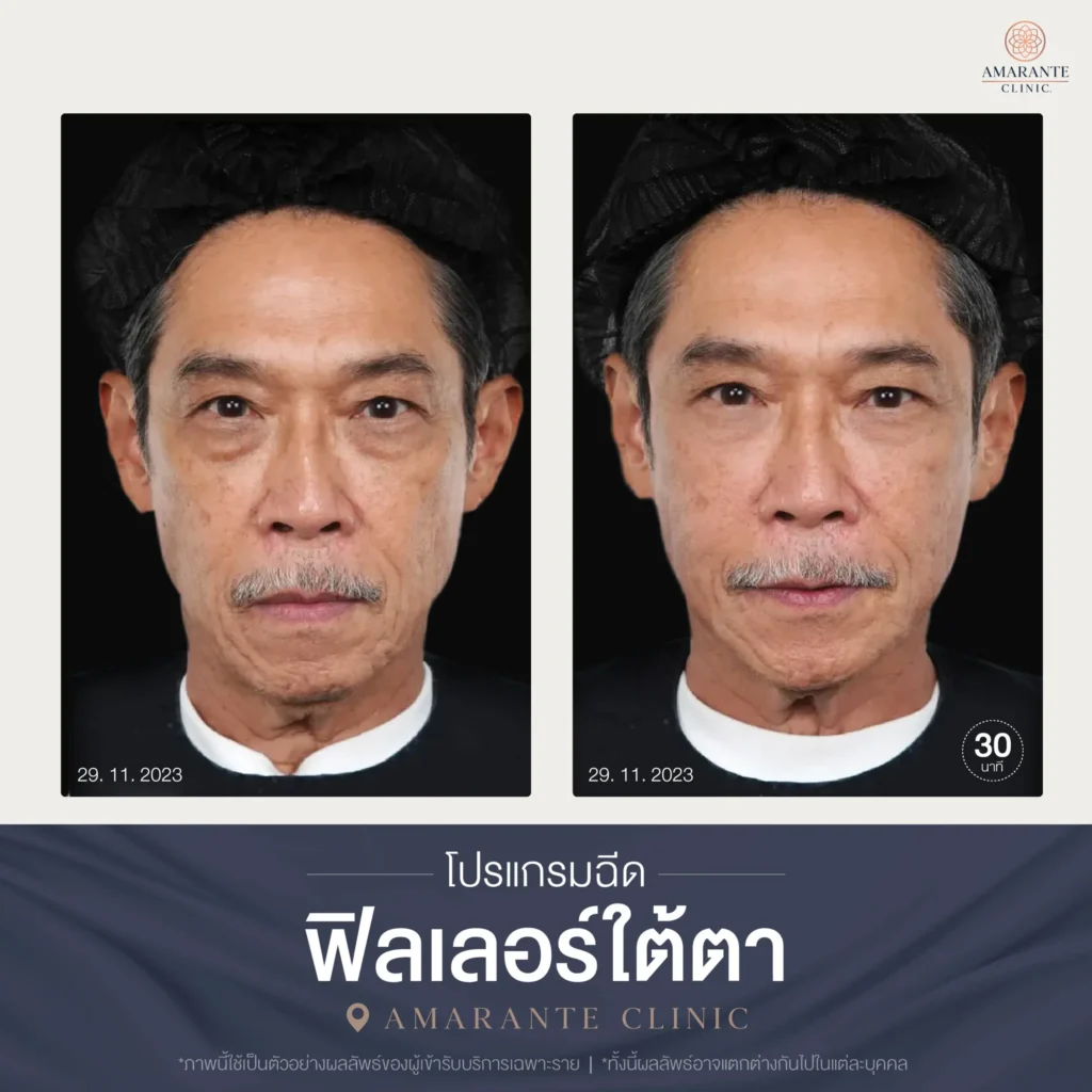 โปรแกรมฉีดฟิลเลอร์ใต้ตา-03-scaled