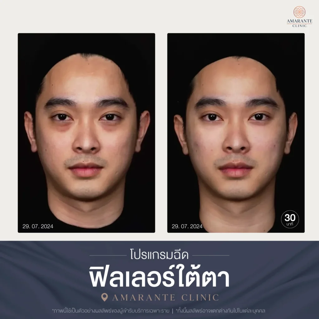 โปรแกรมฉีดฟิลเลอร์ใต้ตา-04-scaled