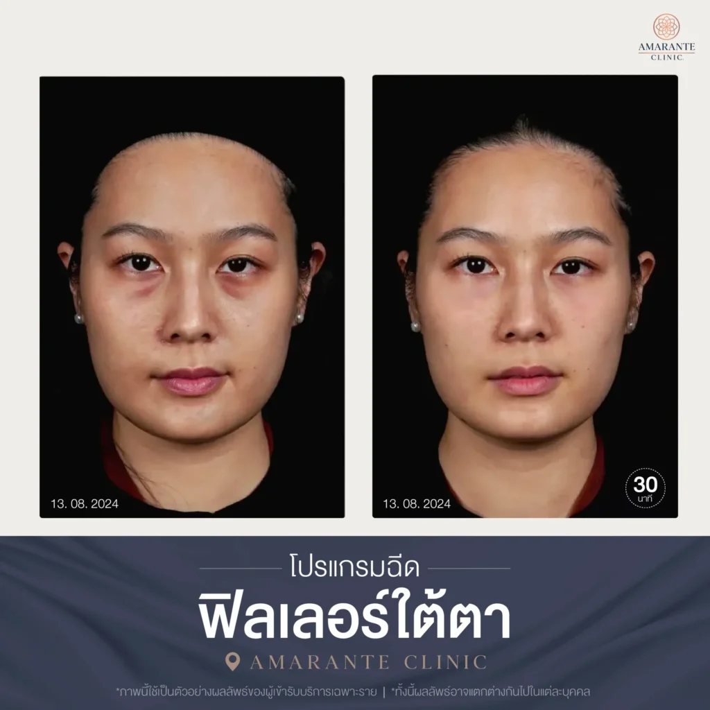 โปรแกรมฉีดฟิลเลอร์ใต้ตา-05-scaled